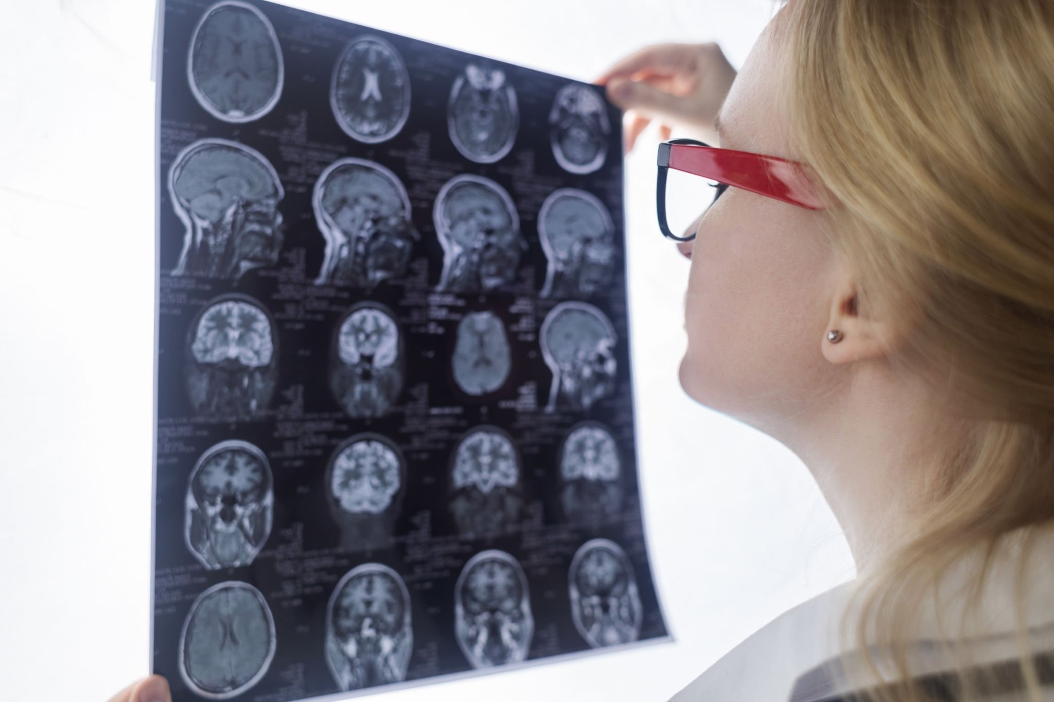 Alzheimer's Disease: Understanding and Preventing Cognitive Decline
