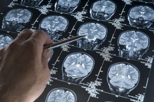 Alzheimer’s Disease: Understanding and Preventing Cognitive Decline