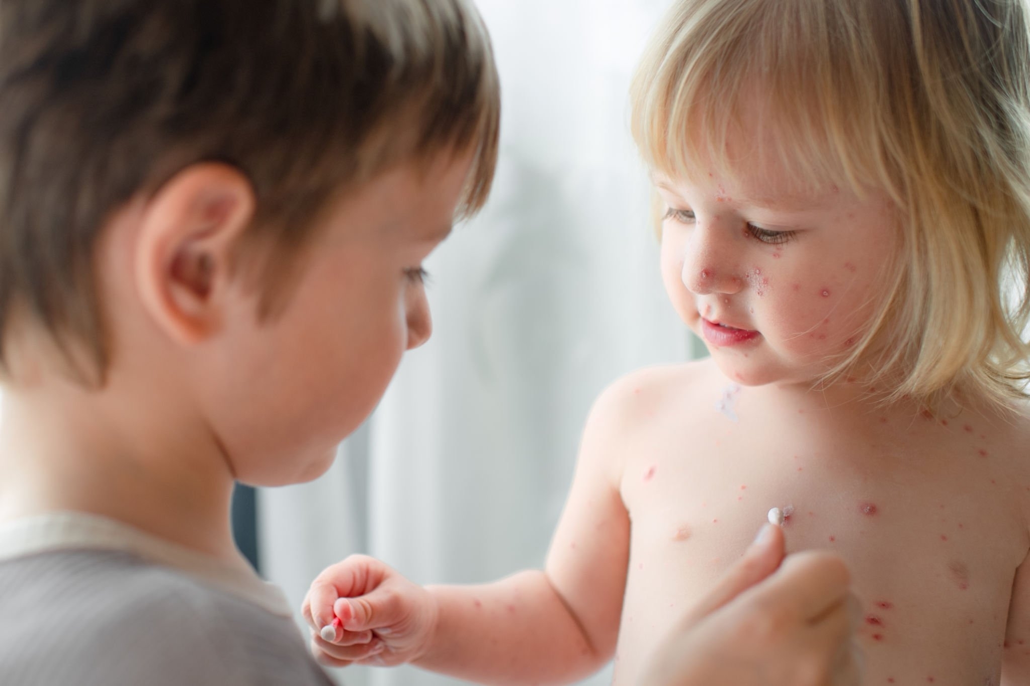 Common Skin Diseases in Children: Causes, Symptoms, and Treatments