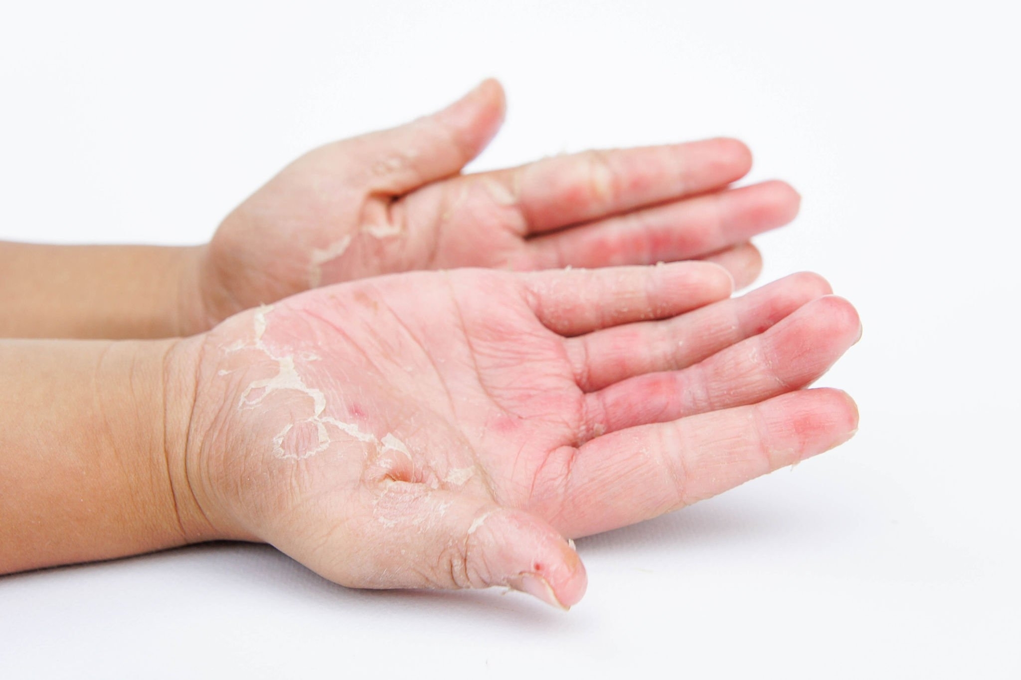 Understanding Psoriasis: A Chronic Skin Disease Unveiled