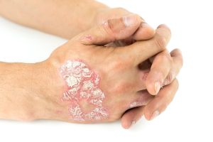Understanding Psoriasis: A Chronic Skin Disease Unveiled